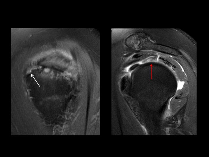 Figure 3 for case tendon of rotator cuff ( RID1948 )